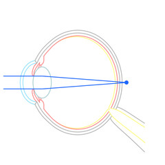 軸性遠視の眼球のイラスト