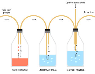 Three bottle system of chest tube insertion Tube thoracostomy Intercostal drainage ICD. Medical procedure vector illustration isolated on white background.