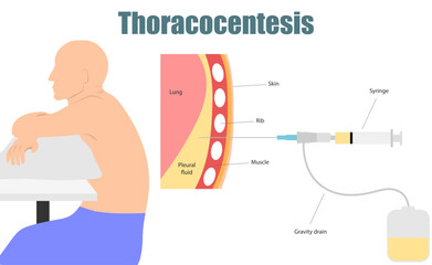 Thoracentesis procedure remove fluid  from around the pleural space. Can help diagnose such as Cancer Tuberculosis Empyema Pulmonary embolism Pancreatitis SLE CHF fungal. Medical procedure vector