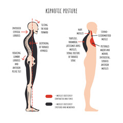 Posture disorders infographics. Kyphotic posture. The side view shows deformation of rounded shoulders, spine curvature, pelvis rotation, stretched and weakened, shortened and tens muscles. Vector.