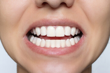 Woman's smile after teeth straightening and whitening. Ideal, beautiful shape of teeth on the upper and lower jaw after installing veneers or braces. Close-up. Patient at a dental orthodontic clinic.