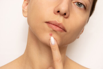 Obraz na płótnie Canvas Close-up portrait of a young beautiful woman pointing at a large inflamed purulent pimple on her chin. Facial skin problems, acne. Hormonal disbalance. Cosmetology and dermatology. Beauty and care