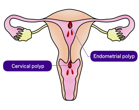 子宮内膜ポリープと子宮頚管ポリープのイラスト