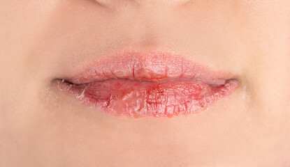 Dried and chapped  female lips