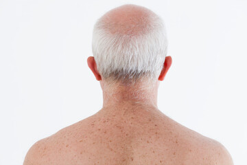 Thinning white hair at vertex or cleric and bare back with spott