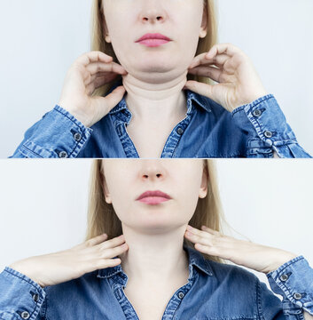 Double chin lift in women. Photos before and after plastic surgery, genioplasty or facebuilding. Chin fat removal and face contour correction. Subcutaneous fat, loss of elasticity, sagging
