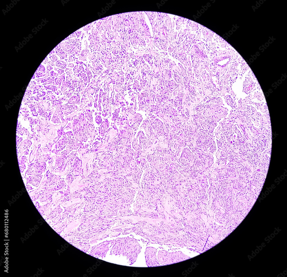 Poster Photomicrograph: Meningioma, the most common type of primary brain tumor