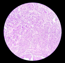 Photomicrograph: Meningioma, the most common type of primary brain tumor
