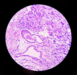 Photomicrograph: Meningioma, the most common type of primary brain tumor