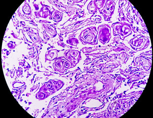 Photomicrograph: Meningioma, the most common type of primary brain tumor