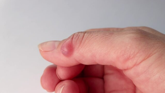 Ganglion cyst (synovial cyst disease) on the thumb of a woman&rsquo;s hand. Selective focus.