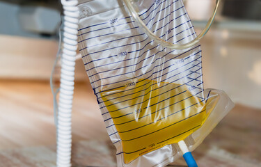 Urine bag with full of pee and pee catheter hang under patient bed.  - obrazy, fototapety, plakaty