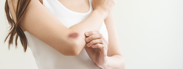 Close up of stain bruise wound on arm, contusion asian young woman, girl an accident fell down...