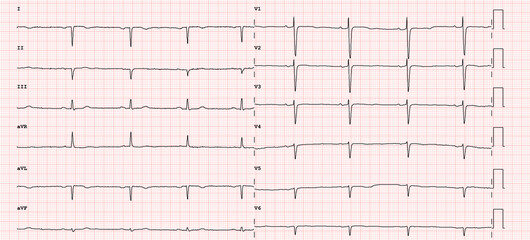 ECG example of  right axial deviation of the heart 12-lead rhythm  - obrazy, fototapety, plakaty