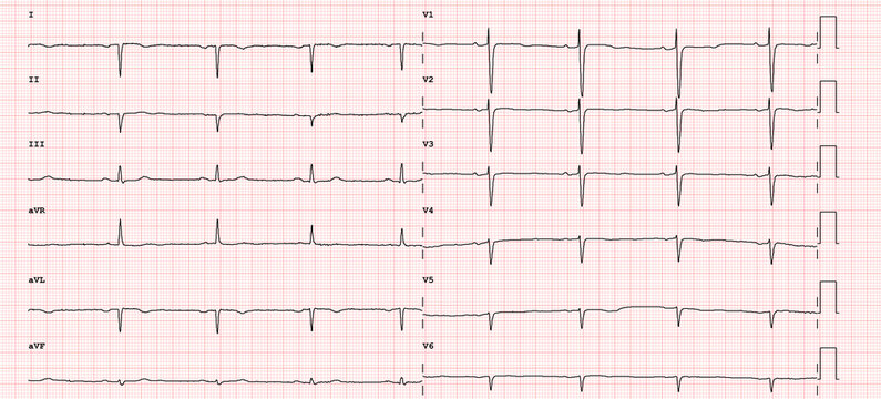 ECG example of  right axial deviation of the heart 12-lead rhythm 