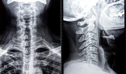 Plain X ray of cervical spine revealed straightened cervical curve, spondylosis osteophytic lipping...