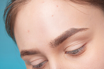 Girl with acne stick round acne patch on her cheek. Using acne patches for treatment of pimple and...