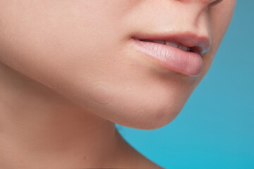 Girl with acne stick round acne patch on her cheek. Using acne patches for treatment of pimple and...