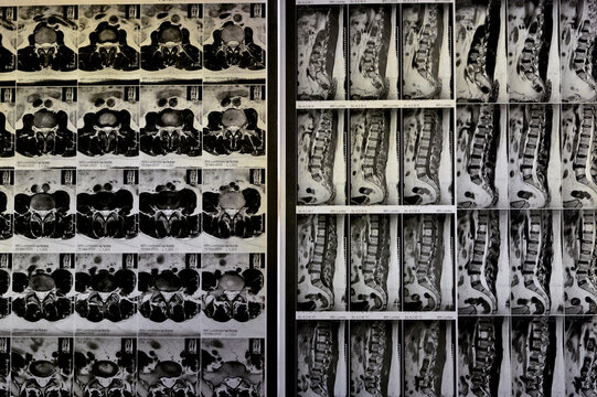 MRI lumbosacral spine without contrast revealed back muscle spasm, Mild L3-L4, L4-L5 disc lesions, Sacral, L5 and T12 vertebral bodies haemangiomata,  straightened lumber curvature, selective focus