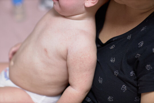 Roseola of the course of the disease in the baby, rash on the skin, the baby is capricious and sluggish