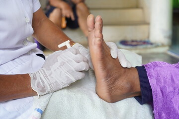Approach diabetes foot common diabetic foot disorder with monofilament , medical equipment. - obrazy, fototapety, plakaty