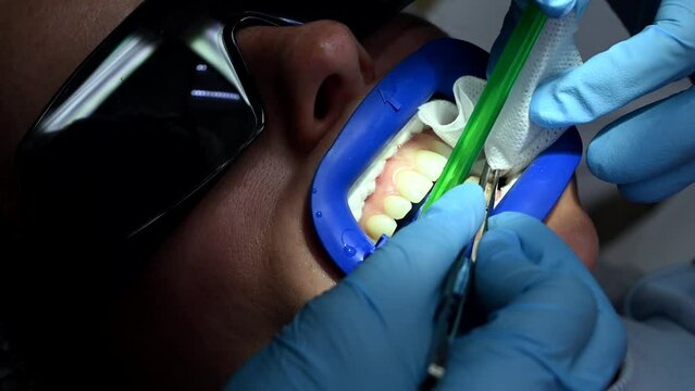 Dental Whitening process in patient mouth. Teeth whitening with UF Lamp, Led Lamp and gel. Dental Extreme Close up Macro Video. Concept of professional dental hygiene. 4k 120 fps slow motion footage