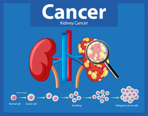 Cancer Development Process in Human Kidney: An Infographic