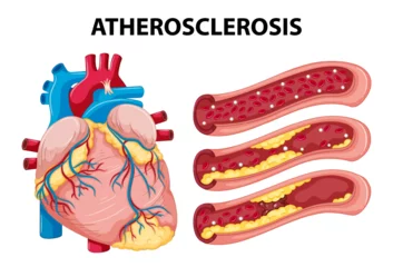 Acrylic prints Kids Science Education on Human Anatomy and Atherosclerosis Development