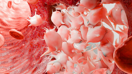 Hemostasis. Red blood cells and platelets in the blood vessel,  vasoconstriction, wound healing process. hemorrhage clot embolisms, Hemophilia. fibrinolysis, injury bleeding coagulation, 3d render