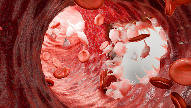 Hemostasis. Red blood cells and platelets in the blood vessel,  vasoconstriction, wound healing process. hemorrhage clot embolisms, Hemophilia. fibrinolysis, injury bleeding coagulation, 3d render