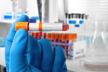 Blood sample for test in laboratory in doctor hands