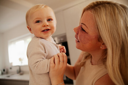Young mother with port wine stain holding baby in kitchen smiling into camera