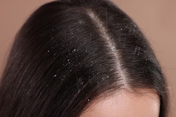 Woman with dandruff problem on beige background, closeup