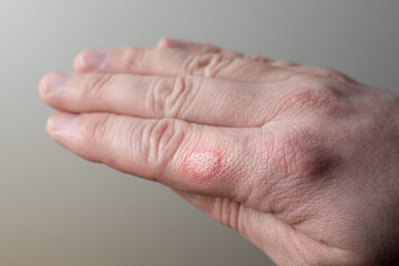Burned skin on a finger of Caucasians man hand