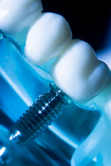 Dental tooth implant