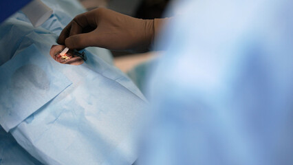 The doctor performs surgery, laser eye correction, close-up. Ophthalmic surgery. Surgeon's hands in...