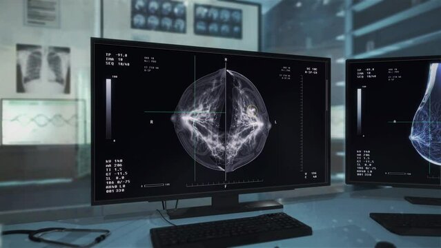 Analysis of the cancer disease cells found in the patients breast at the clinic. Deadly breast disease analysis by the medical computer. Analysing the stage of the breast disease growth.
