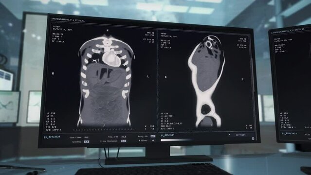 X-ray Analysis Software Inspects Bones In Chest To Diagnose Injury. Medical Analysis In Hospital. Anatomical X-Ray Scan. Hospital Laboratory X-ray Imaging. Screening Analysis. Healthcare Hospital