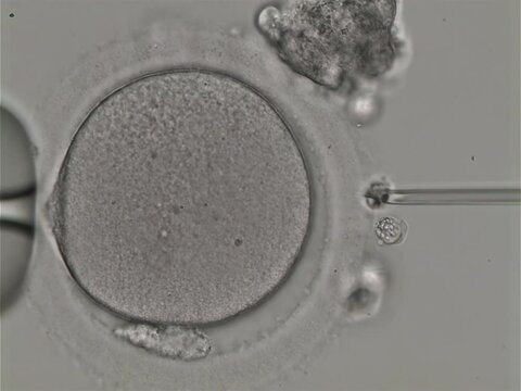 Monitoring medical procedure with surgical precision. Monitoring medical procedure of the In Vitro Fertilisation. Monitoring medical procedure of impregnating the womens egg. Fertility.