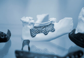 Facial bone of lower human jaw individual prosthesis printed on 3D printer from metal powder....
