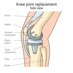 knee joint replacement structure diagram hand drawn schematic vector illustration. Medical science educational illustration - obrazy, fototapety, plakaty