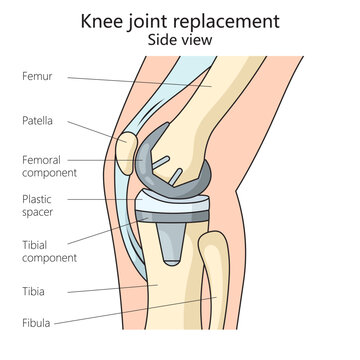 knee joint replacement structure diagram hand drawn schematic vector illustration. Medical science educational illustration