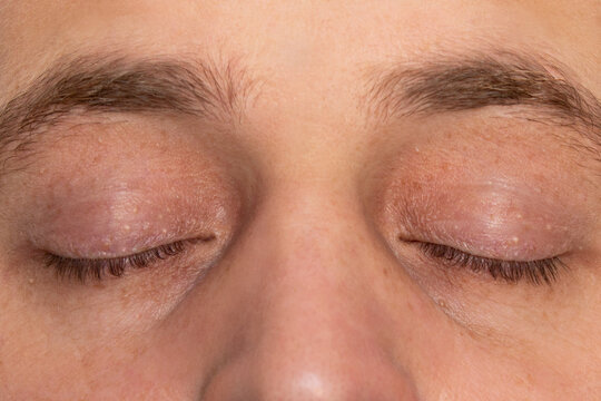 Milia or milium on the upper and lower eyelids of a man. Whiteheads, papillomas, pimples, millet, wen, cysts on the skin around the eyes. Face close-up. Dermatology and skin care