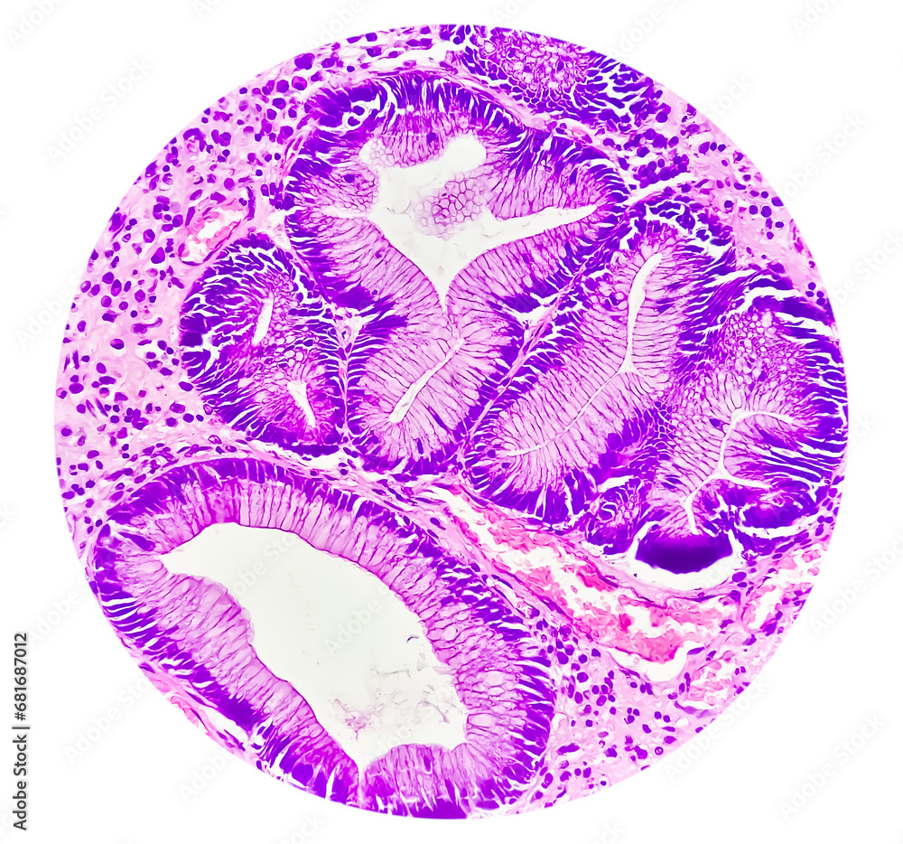 Wall mural Photomicrographic view of histological stained slide showing carcinoma. Adenocarcinoma