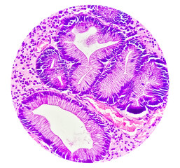Photomicrographic view of histological stained slide showing carcinoma. Adenocarcinoma - obrazy, fototapety, plakaty