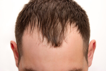 Obraz premium Head shot of a man with a receding hairline on a white background. Male pattern baldness. Androgenic or androgenetic alopecia. Hair loss. Forehead close-up, front view. Hair care and treatment concept