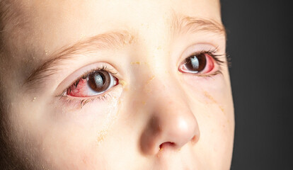 red eye of a patient with human conjunctivitis, ill allergic eyes in babies, children - obrazy, fototapety, plakaty
