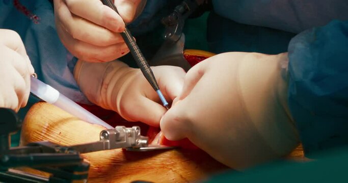 Close up of cancer surgery. Team of skilled surgeons remove cancer cells from stomach with modern laser technology,cut out tumor from patient body,working on open wound.Handheld documentary style shot