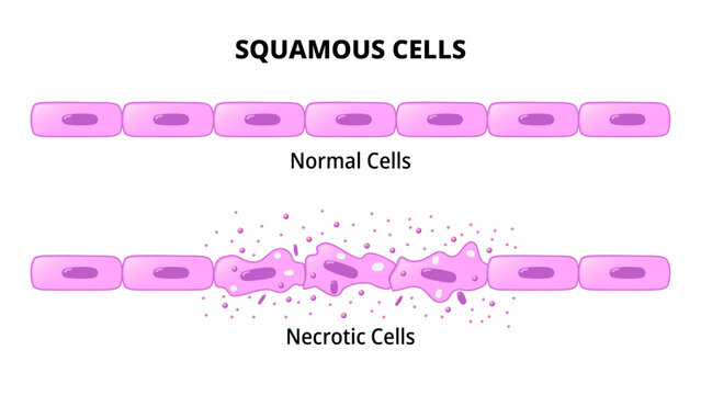 Squamous Cells - Normal Epithelial Cell - Necrotic Cell - Histology Medical Vector Illustration