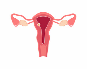 Embryo implantation embryo wall of the uterus embryo development from ovulation to implantation female reproductive system  - obrazy, fototapety, plakaty
